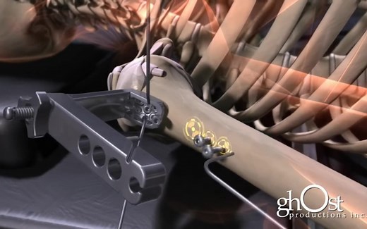【3D医学动画】震撼▁剧情演示全身骨折修复