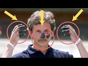 Frost Bite Symptoms - Frost Bite Fingers and Frostbitten Feet - Cold Burn and Hypothermia