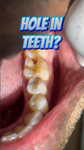 Hole in Teeth Treated with Indirect Restoration