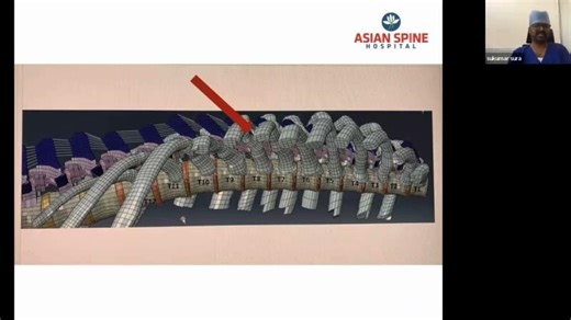 Endoscopic thoracic transforaminal discectomy- Dr Sukumar Sura for SEAS | Rao Prashanth