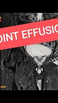 Hip Joint Effusion with Bone Marrow Edema.