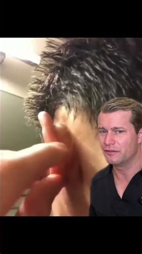 Big juicy ear cyst! #cyst #pimple #pop #fyp #explosion