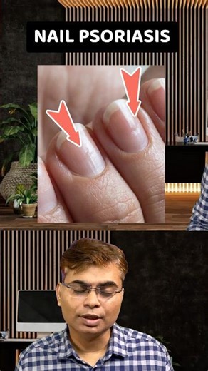 Nail psoriasis | सोरायसिस #shorts #psoriasis #skincare