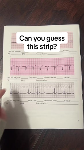 Just becuase the qrs seems in better doesn't mean you can't interpret it. Follow the same steps! It just looks this way depending on which lead/vector we are reading the strip from and which direction the electrical impulse is going towards. #ekg #ecg #ekginterpretation