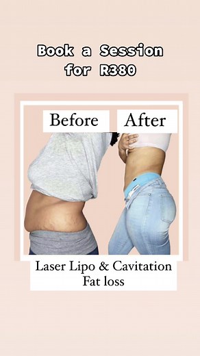 Ultrasound Cavitation for Fat Cell Reduction: A Non-Surgical Approach