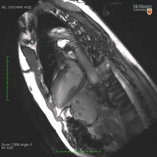MRI video of the human heart