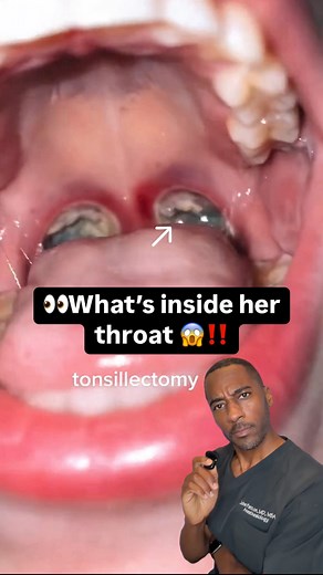 Ever seen a throat that looks like this?? 👀 Here’s the quick rundown on tonsillectomies. 🎥: kirsten.walz (TT) #anesthesia #doctor #reaction #meded #health | John W. Patton, III, MD, MBA
