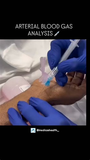 Medical & Health ⚕️ on Instagram: "Arterial Blood Gas (ABG) Analysis measures oxygen (PaO₂), carbon dioxide (PaCO₂), blood pH, bicarbonate (HCO₃⁻), and oxygen saturation (SaO₂) from arterial blood. It assesses respiratory and metabolic function, acid-base balance, and oxygenation status. Commonly used in critical care to diagnose and monitor respiratory failure, metabolic disorders, and response to oxygen or ventilator therapy. . . Dm for credit or removal 👏🏻 . . #doctors #needle #injection #a