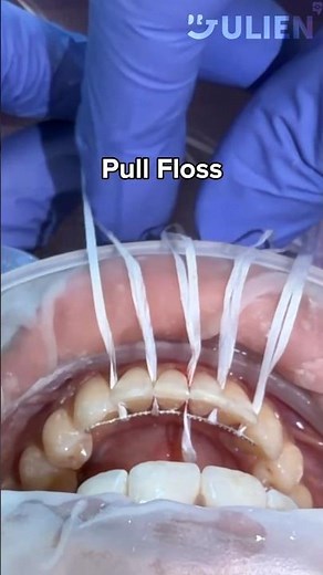 How to Cement a Permanent Retainer #braces #satisfying