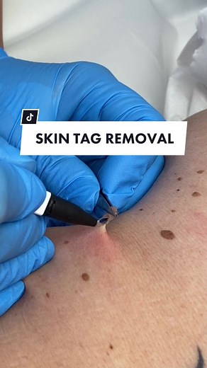 Always very satisfying! #skintagremoval #skintag #hugeskintagremoval #perfectskinsolutions #drdevpatel