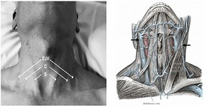 Measuring the Jugular Venous Pressure: Do Not Turn the Head!