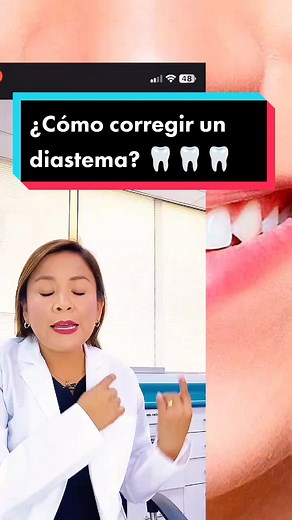 Cómo corregir un diastema: tratamiento y recomendaciones