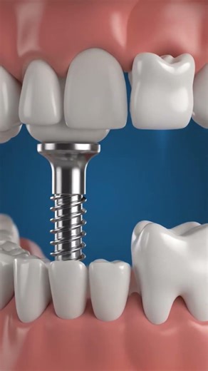 Which one is better. Implant vs bridge.
