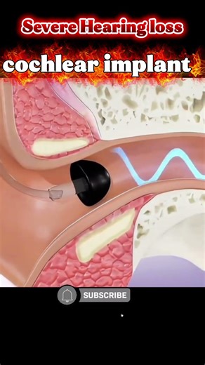 Cochlear Implant Explained in 3D 🎧 | Medical Animation #Shorts #Cochlear Implant