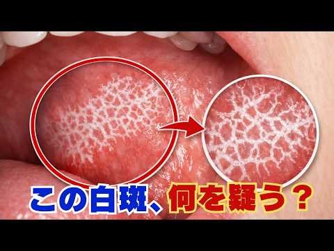 Don't miss it during your home dental visit! Oral lichen planus explained clearly: pathology, dif...