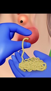 Satisfying Pimple Popping #asmr #fyp | Meng's Stop Motion