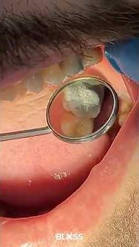 Amalgam Build-Up: Restoring Strength to a Damaged Tooth 🦷