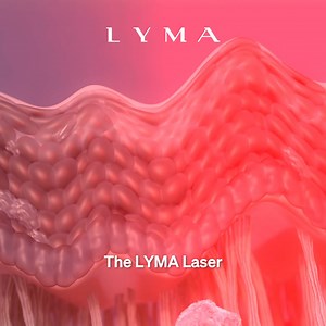 3.3K reactions · 50 shares | This is how the LYMA Laser works inside the skin, powerful cutting-edge science that delivers revolutionary results: skin density increases, skin becomes smoother and wrinkles decrease. | LYMA | Facebook