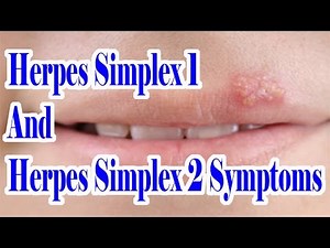 Herpes Simplex 1 And 2 Symptoms : Which Herpes You Are Suffering From HSV 1 Or HSV 2