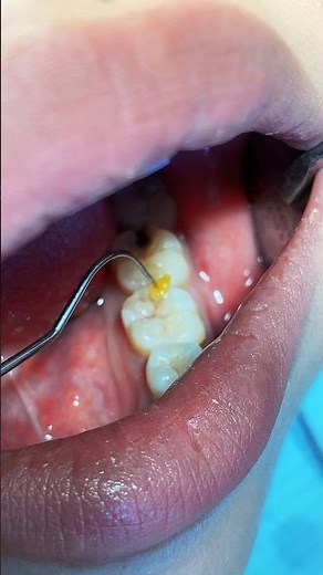 Sensitive tooth due to large cavity #dentist #dental #cavity