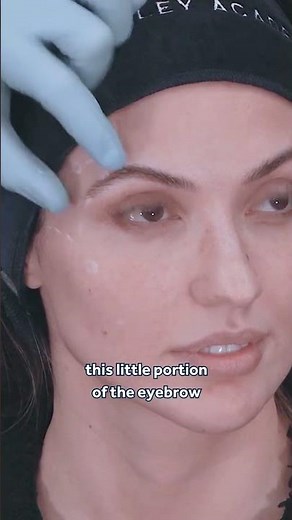 Lifting the Tail of the Brow Through Temple Filler 💎 Evidence-Based Techniques from the GEM©️ Clinic