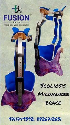 Milwaukee brace #scoliosis #scoliosisawareness