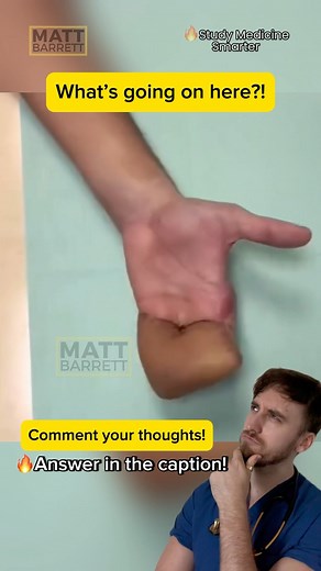 Dr Matt Barrett MBBS BSc | Study Medicine Smarter | ⚠️ Tap here for the answer! ✅ Spoiler alert: Degloving injury + Flap A 💡degloving injury occurs when skin and tissue are torn away from... | Instagram