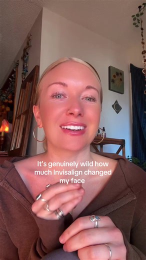 FYI: it was medically necessary. I loved my bunny teeth too :) #teethtransformation #dental #invisalign #braces #ortho