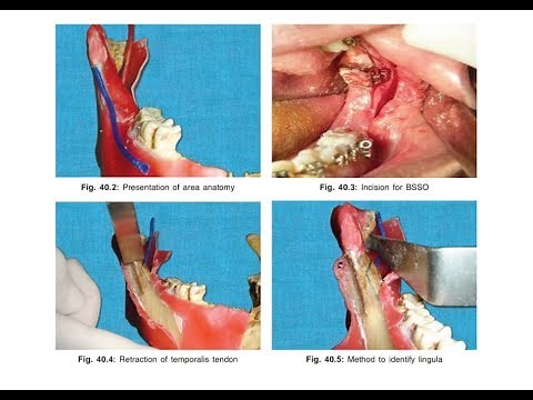 Orthognathic surgery/part 2/ Mandibular Orthognathic surgical procedures