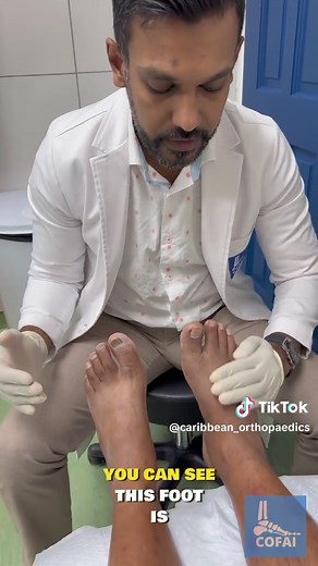 Injury-Triggered Charcot’s Foot🦶🏻 #fyp #charcot #neuropathy #foot #toes #fracture #orthopedics #diabetes #diabeticfoot