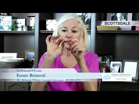 Essure Fallopian Tube Removal Explained by Scottsdale Gynecologist Deborah Wilso