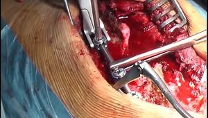 Posterior corpectomy in acute spinal cord injury secundary to spine dislocation (Spanish)