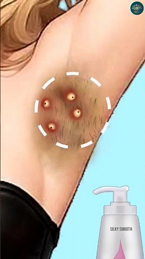 😱 Armpit Pimple Popping & Hair Removal ASMR Animation | AD SOUL ASMR Shorts #asmr #shorts