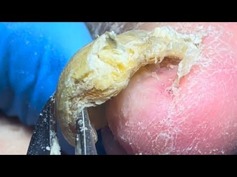 Severely Deformed Nails Make Inconvenient For The Elderly To Cut Their Nail【PedicureMaster LinJun】