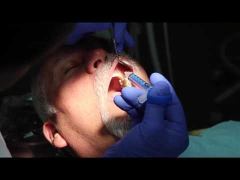 My Technique: How I Use Anutra for a Palatal Infiltration