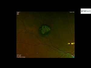 CHRPE (Congenital Hypertrophy of the Retinal Pigment Epithelium) - Sabrina Khalil - 2023 11 10