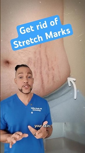 How to get rid of stretch marks