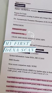 54 reactions · 10 comments | "Last year, I was diagnosed with severe bone loss, at age 45... ONE year later, my DEXA scan shows BIG improvements to my overall bone health!" CONGRATULATIONS Amanda! We're elated to see you're well on your way to rebuilding your bone density  You too can increase your bone density, just like Amanda. Visit the link HERE: https://algaecal.info/40GtGo2 Via: https://www.instagram.com/unapologetically_amanda/ | AlgaeCal | Facebook