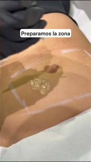 ¿Alguna vez te has preguntado como es el paso a paso del tratamiento de #criolipolisis ?