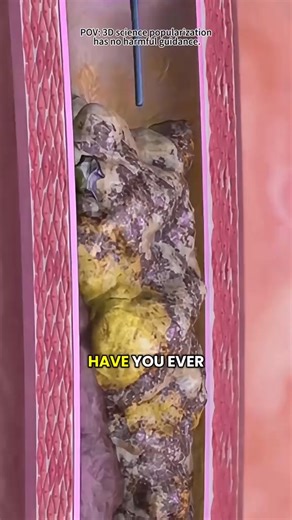 How Laser Atherectomy Procedure Is Performed? (3D Animation) #laseratherectomy #atherectomytreatment #plaque #plaqueremoval #atherectomy #vaporizingcoronaryblockage #medical3danimation #3dmedicalanimation | Daliy Healthy Tip's