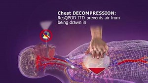 The ResQPOD® impedance threshold device (ITD) is a simple, non-invasive device that delivers intrathoracic pressure regulation (IPR) therapy during basic or advanced life support CPR to improve perfusion. https://buff.ly/2QGuvu6 | EMS1 Products