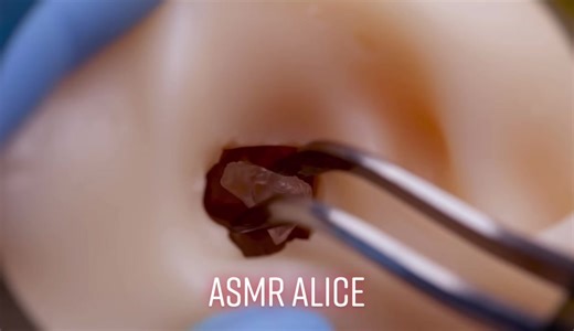 耳かきASMR：耳奥から石のようなカチカチの耳垢を除去