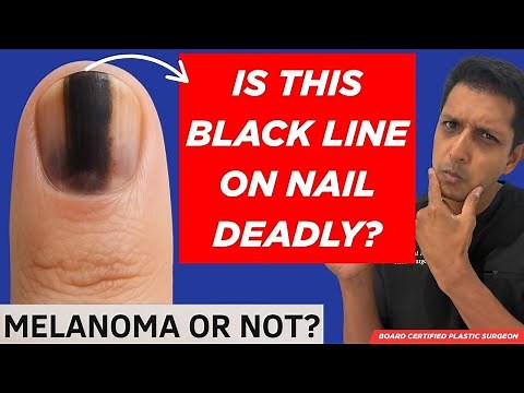 Black Line On Your Nail? Here's How To Tell If It's Skin Cancer