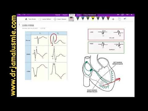 LBBB and RBBB (left VS right bundle branch block)- Dr Jamal USMLE - Cardiology ECG lecture