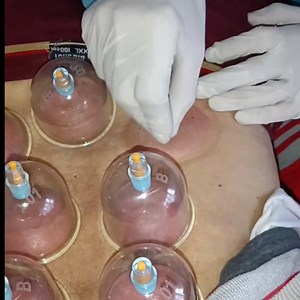 Hijama for diffuse disc bluge #L3, #L4, #L5,# S1 and #left leg pain, #numbness, #tingling #hijama | Daily Health & Beauty Tips | Facebook