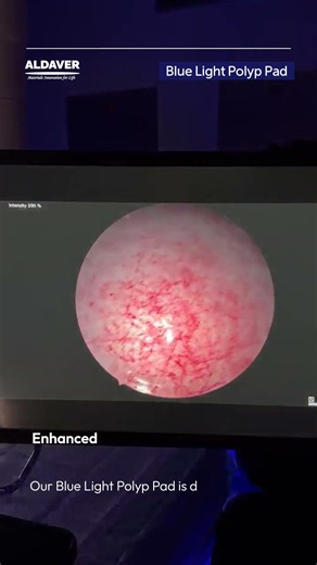 Can You Spot the Polyp Under Blue Light? 🔍