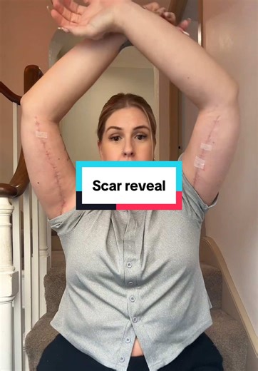 Understanding Scar Healing After Arm Lift Surgery