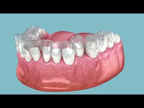 Invisalign braces or invisible retainer make bite correction