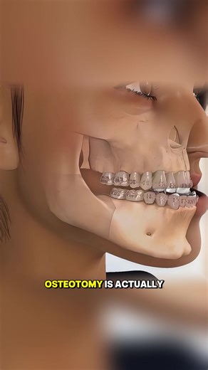 How Jaw Correction Surgery Osteotomy Explained (3D Animation) #jawcorrectionsurgery #osteotomy #orthognathicsurgery #medical3d #3danimation
