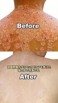 【衝撃】これが乾癬治療のリアルな結果